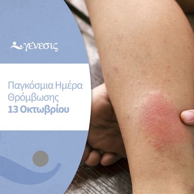 θρόμβωση